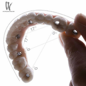 Fixfogsor implantátum segítségével