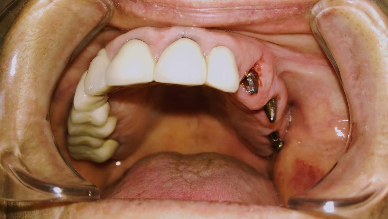 azonnal terhelhető implantátum